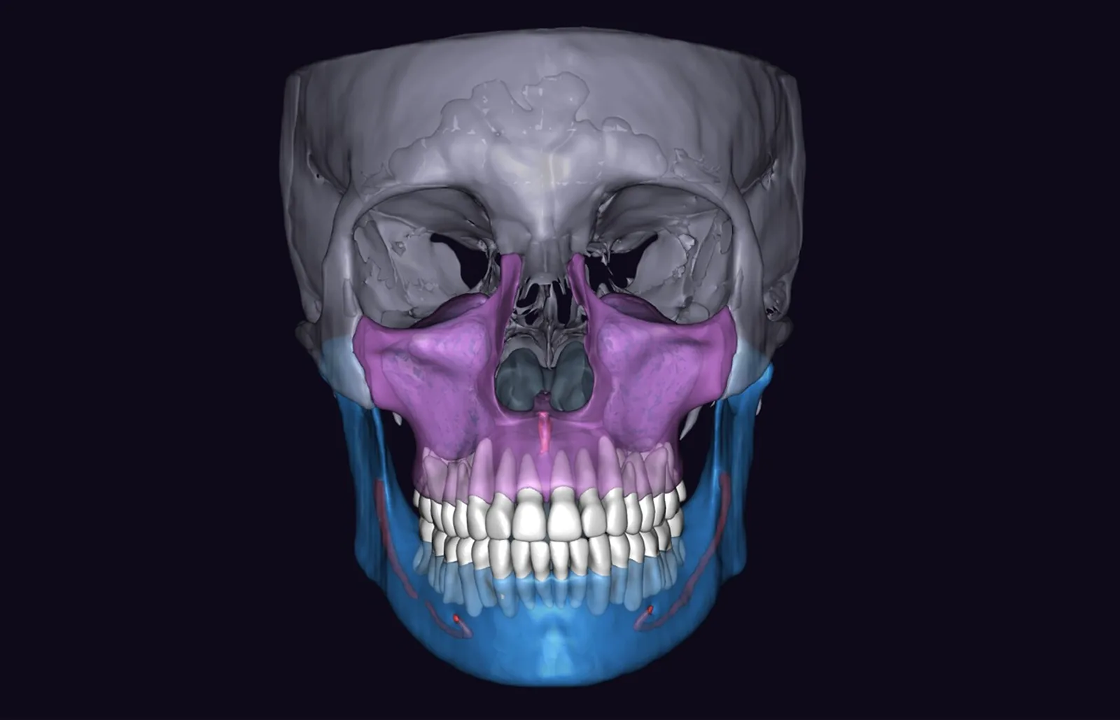 Full craniofacial 3D segmentation generated from a CBCT scan