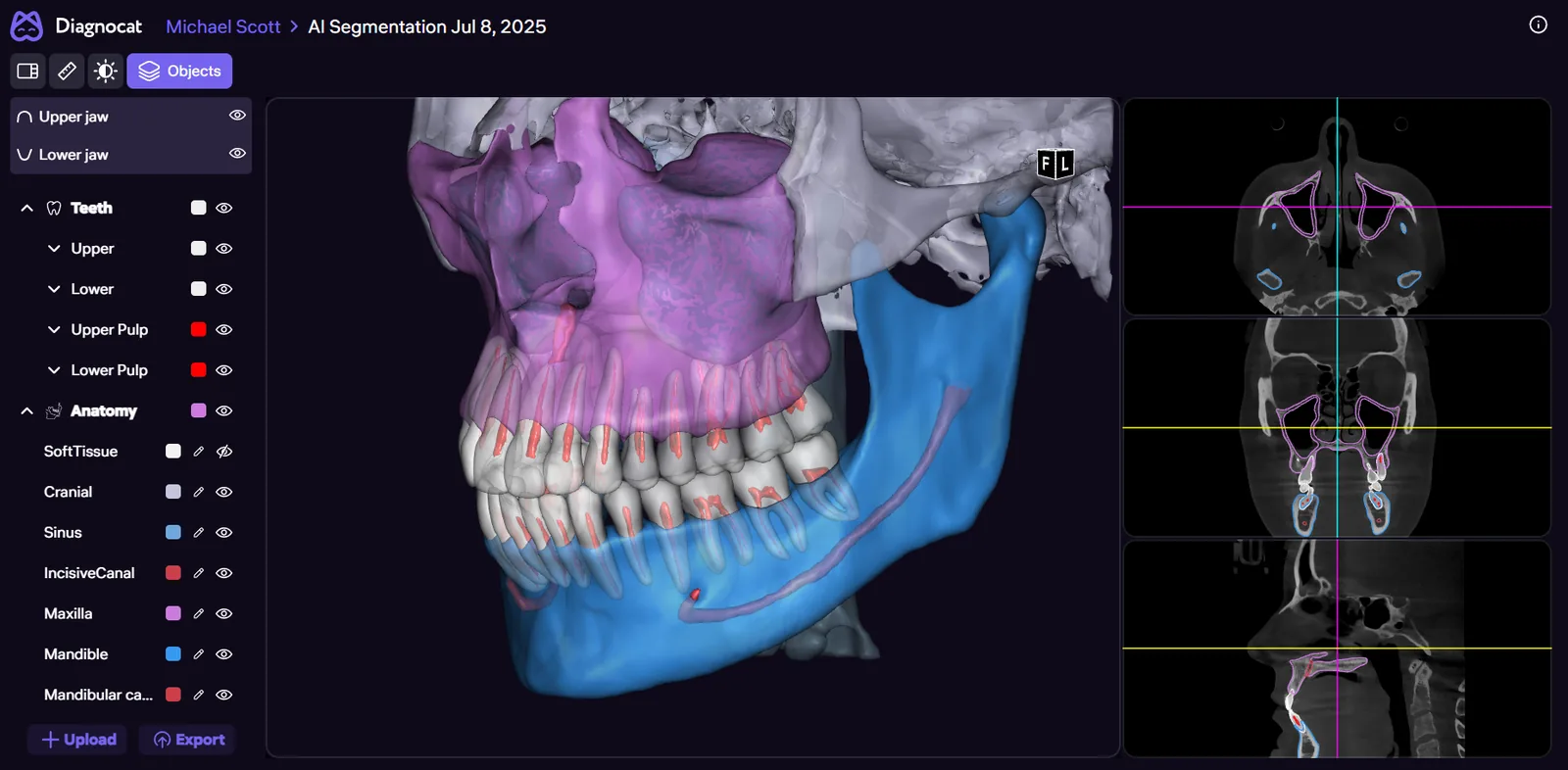 Anatomy layer panel with toggles for sinus, maxilla, mandible and canals