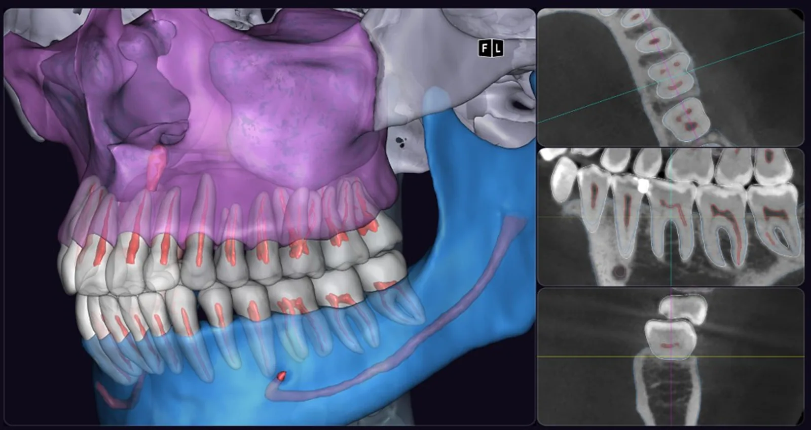 Segmented roots, pulp and mandibular canal beside cross-sectional slices