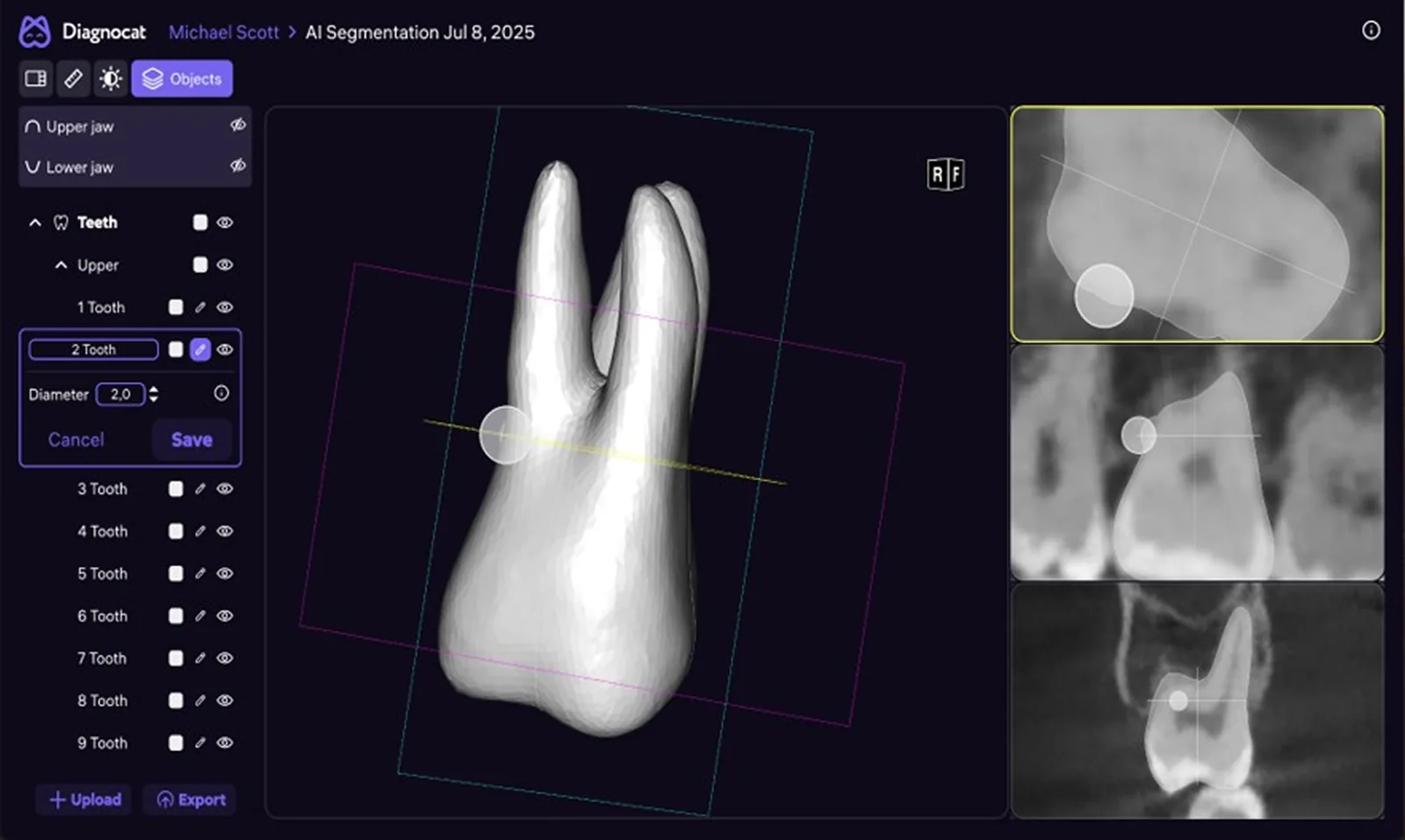 Single-tooth segmentation with an editable implant diameter control